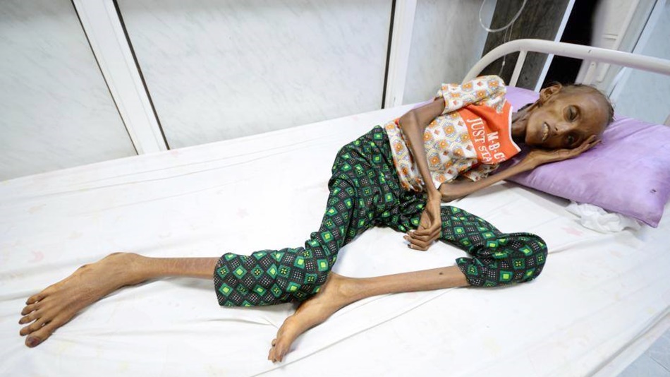 ขั้นวิกฤต! ชาวเยเมนครึ่งประเทศต้องประสบปัญหาขาดสารอาหาร - ข่าวสด