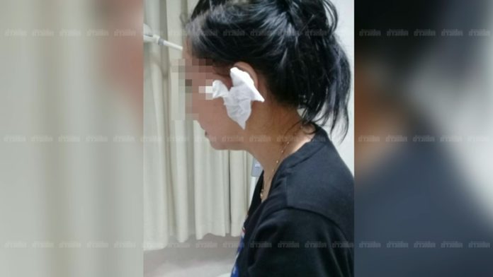 สภาพใบหูที่ถูก ร.ต.อ.ตบจนแก้วหูทะลุ