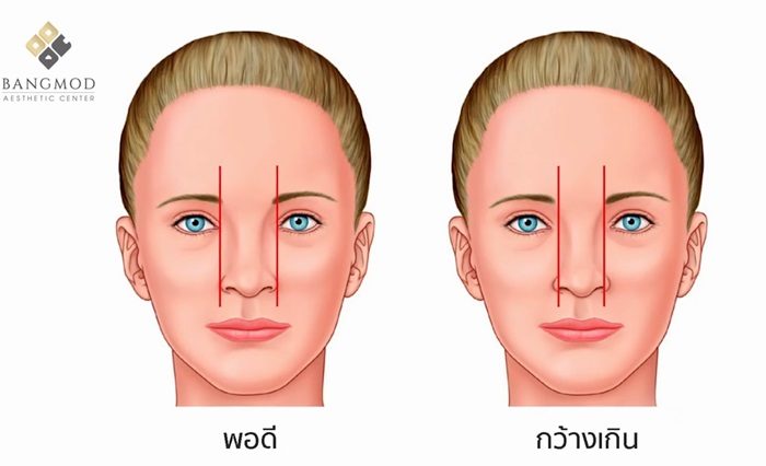 เสริมจมูก เป็นธรรมชาติ