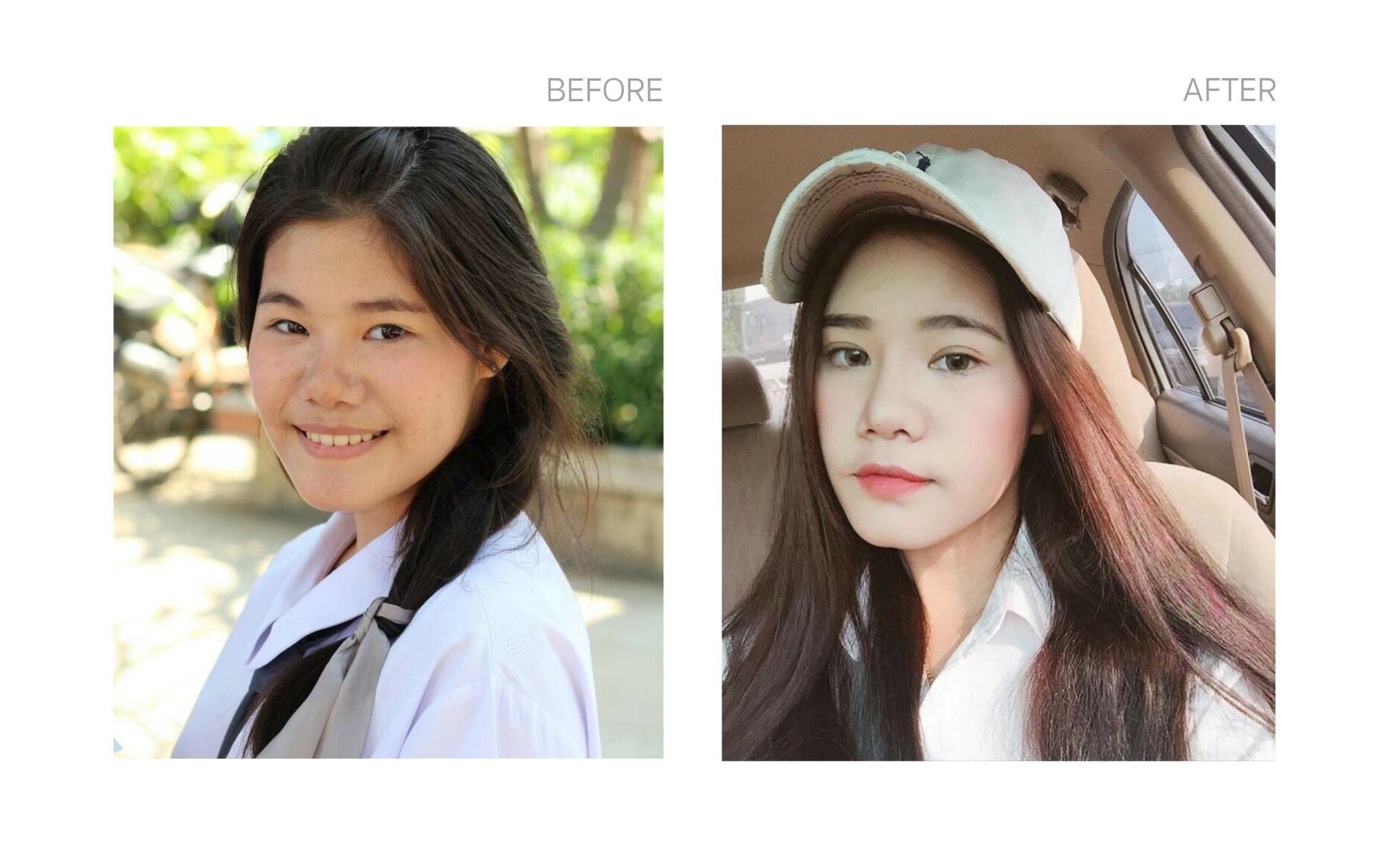 เสริมจมูก อย่างเป็นธรรมชาติ