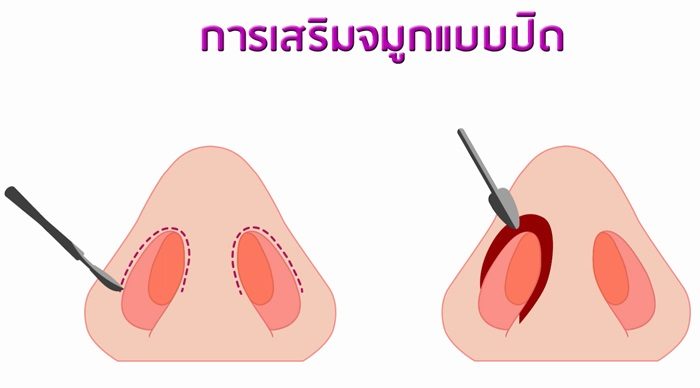 เสริมจมูก เป็นธรรมชาติ