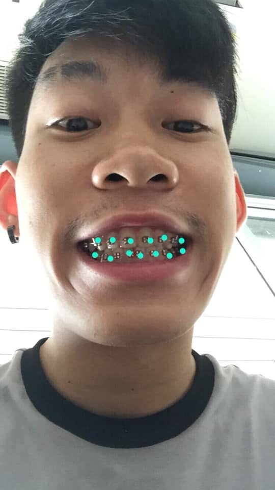 เหล็กดัดฟัน เหล็กดัดฟัน