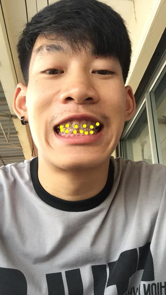 เหล็กดัดฟัน เหล็กดัดฟัน