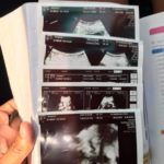 ข้องใจ เมียท้องขาบวม หายใจติดขัด หมอบอกปกติ สุดท้ายครรภ์เป็นพิษดับ ลูกเข้าไอซียู!
