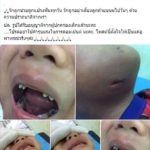 เตือนใจพ่อแม่อย่าให้ลูก ฟันผุ หนูน้อยสุดทรมานนอน รพ. ยาว เจาะคางระบายหนอง!