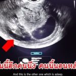 ป๊อก-มาร์กี้ พาไปดูลูกแฝด เริ่มมีแขนขา-ดิ้นเก่ง เขินหมอไขข้อสงสัยเรื่องเซ็กซ์(คลิป)