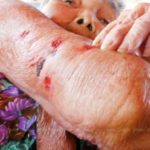 ลูกชายพอใจ รพ.หนองคาย ขอโทษ เหตุ ย่าวัย80แขนเน่าติดเชื้อ หามส่งรพ.อีกรอบ