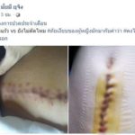 สาวเตือน! ปวดท้องประจำเดือน อย่าชะล่าใจ สุดท้ายต้อง ตัดรังไข่ทิ้ง 2 ข้าง