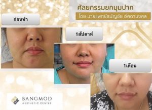 ปากกระจับ