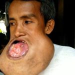 เนื้องอกล้นปาก หนุ่มบาดเจ็บขากรรไกรจากเล่นบาส ทรมานนาน7ปี