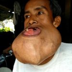 เนื้องอกล้นปาก หนุ่มบาดเจ็บขากรรไกรจากเล่นบาส ทรมานนาน7ปี