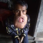 เนื้องอกล้นปาก หนุ่มบาดเจ็บขากรรไกรจากเล่นบาส ทรมานนาน7ปี