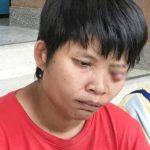 เจ็บจนนอนไม่ได้! สาวป่วยเนื้องอกในตา ทรมานมา 29 ปี ไร้เงินรักษา