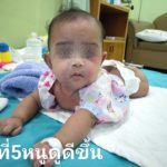 ลูกน้อยป่วย หนังลอกทั่วตัว ร้องเจ็บทุรน แม่ใจจะขาด จำจนตาย อย่าให้ใครหอม-อุ้ม