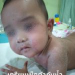ลูกน้อยป่วย หนังลอกทั่วตัว ร้องเจ็บทุรน แม่ใจจะขาด จำจนตาย อย่าให้ใครหอม-อุ้ม