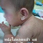 ลูกน้อยป่วย หนังลอกทั่วตัว ร้องเจ็บทุรน แม่ใจจะขาด จำจนตาย อย่าให้ใครหอม-อุ้ม
