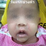 ลูกน้อยป่วย หนังลอกทั่วตัว ร้องเจ็บทุรน แม่ใจจะขาด จำจนตาย อย่าให้ใครหอม-อุ้ม