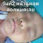 ลูกน้อยป่วย หนังลอกทั่วตัว ร้องเจ็บทุรน แม่ใจจะขาด จำจนตาย อย่าให้ใครหอม-อุ้ม