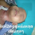 ลูกน้อยป่วย หนังลอกทั่วตัว ร้องเจ็บทุรน แม่ใจจะขาด จำจนตาย อย่าให้ใครหอม-อุ้ม