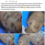 แม่โวย! ลูกสาว 5 ขวบ โดนหมาขย้ำ หน้าเหวอะ ตาหวิดบอด เจ้าของจ่าย 1 พัน ค่าทำขวัญ