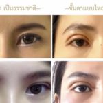 ศัลยกรรมยอดฮิต ที่มาแรงไม่เคยตก 3 อันดับแรก และเทรนด์ฮิตปี 2562
