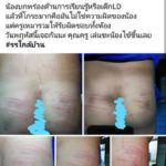 แม่เด็กแอลดีโวยครู ใช้หวาย ฟาดก้นลูก จนช้ำเลือด รับจะจ่ายเยียวยา แต่กลับเงียบ