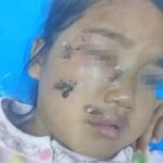 แม่โวย! ลูกสาว 5 ขวบ โดนหมาขย้ำ หน้าเหวอะ ตาหวิดบอด เจ้าของจ่าย 1 พัน ค่าทำขวัญ