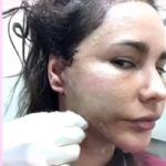 โชว์หน้าใหม่ แหม่ม วิชุดา หลังทุ่มเงินล้านรอยไหม-ปลูกผม 3,000 เส้น