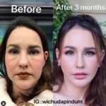 โชว์หน้าใหม่ แหม่ม วิชุดา หลังทุ่มเงินล้านรอยไหม-ปลูกผม 3,000 เส้น