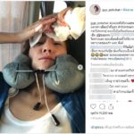 หวิดเสียโฉม! "จิ๊บ ปกฉัตร" หัวแตกเลือดอาบ เย็บถึง 7 เข็ม แถมทิ้งท้ายเผื่อนักเสี่ยงโชค