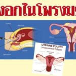 เนื้องอกในโพรงมดลูก เรื่องที่ผู้หญิงควรใส่ใจ : รายงานพิเศษสุขภาพ