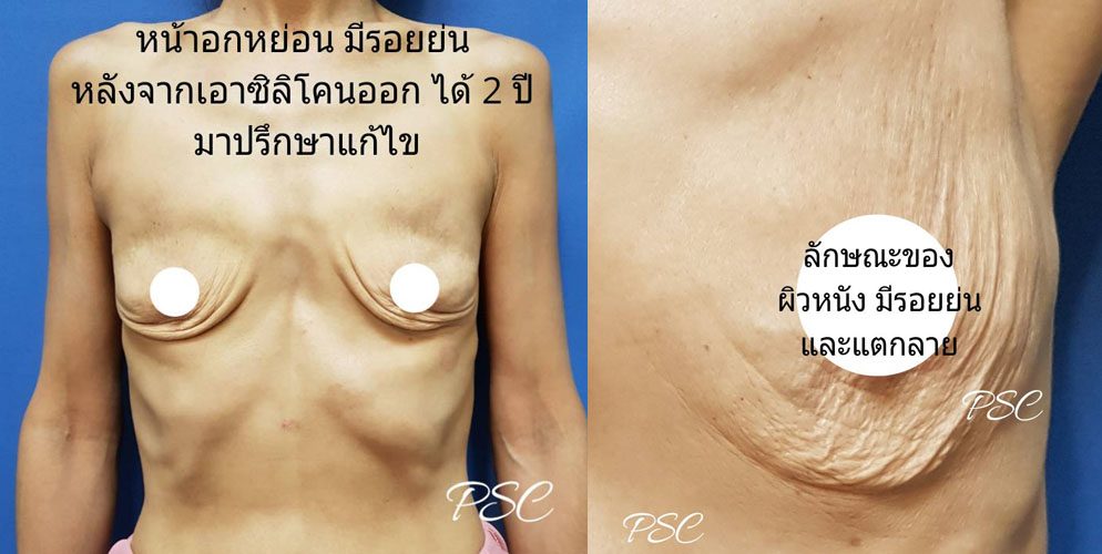 อึ๋ม(ปลอม)อ่วม!! ยัดแล้วถอด เสี่ยงนมเหี่ยว!?! อึ๋ม(ปลอม)อ่วม!! ยัดแล้วถอด เสี่ยงนมเหี่ยว!?!