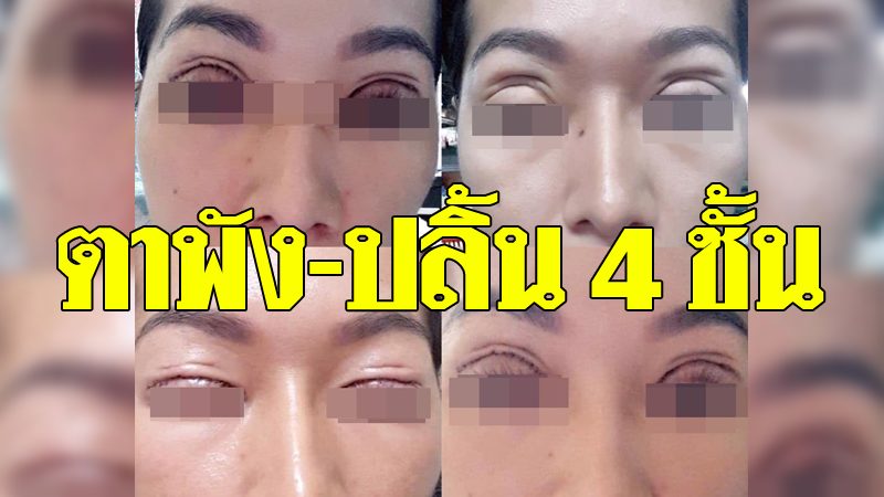 พังเพราะอาจารย์หมอ! สาวทำตา 2 ชั้น ออกมาตกใจได้ 4 ชั้น แถม