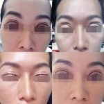 พังเพราะอาจารย์หมอ! สาวทำตา 2 ชั้น ออกมาตกใจได้ 4 ชั้น แถมตาปลิ้นแสบ
