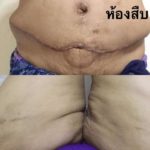 เกือบสิ้นชีพ! สาวดูดไขมันแขนขา ผ่าตัดหน้าท้องย้ายสะดือ ช็อกหัวใจหยุดเต้น 2 นาที