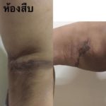 เกือบสิ้นชีพ! สาวดูดไขมันแขนขา ผ่าตัดหน้าท้องย้ายสะดือ ช็อกหัวใจหยุดเต้น 2 นาที