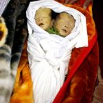สลดแฝดเยเมนร่างเดียวสองศีรษะ สังเวยสงคราม ไร้สนามบินส่งไปต่างประเทศ