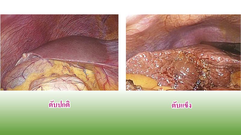 ปลูกถ่ายตับระยะสุดท้าย