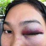 นักร้องดัง เบน ชลาทิศ ต่อยแฟนคลับสาว-ตาบวมปูด ตบหน้าซ้ำ คาร้านดังทองหล่อ