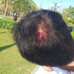 เอกชัย โดนอีก 2 คนร้าย พร้อมไม้-ท่อแป๊ป รุมตีหัวแตก หลังให้การปมร้อง ‘หมอเหรียญทอง’