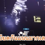 ป๊อก วางแผนคลอด ตื่นเต้นคุณพ่อจะตัดสายสะดือ ตัดสินใจเก็บสเต็มเซลล์ให้ลูกแฝด(คลิป)