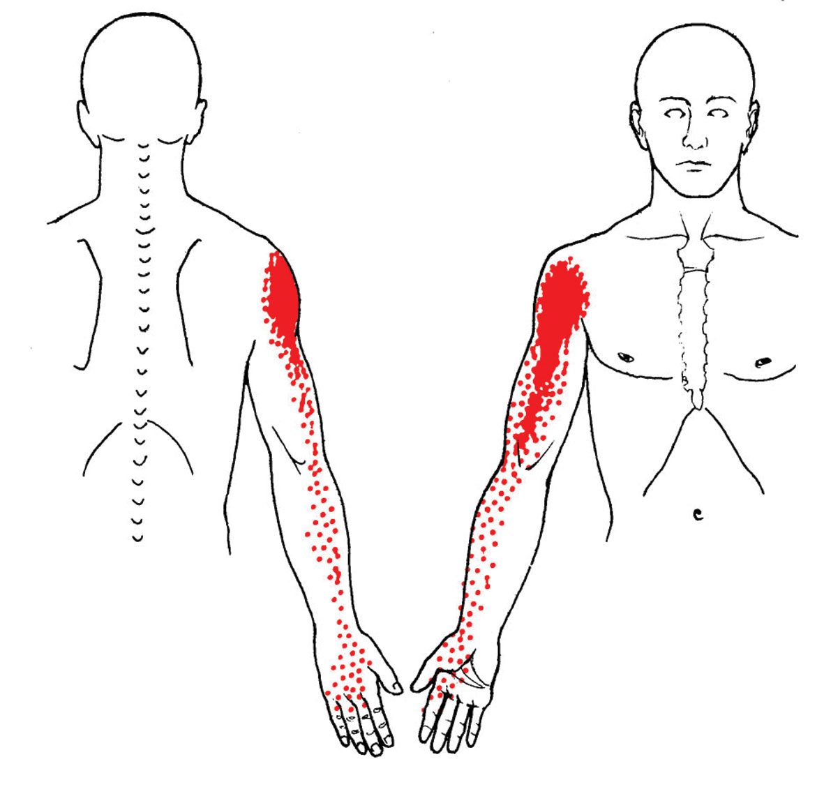 Карта триггерных точек. Миофасциальный синдром триггерные точки. Массаж триггерных точек что это. Триггерные точки и отраженная боль. Массаж триггерных точек.