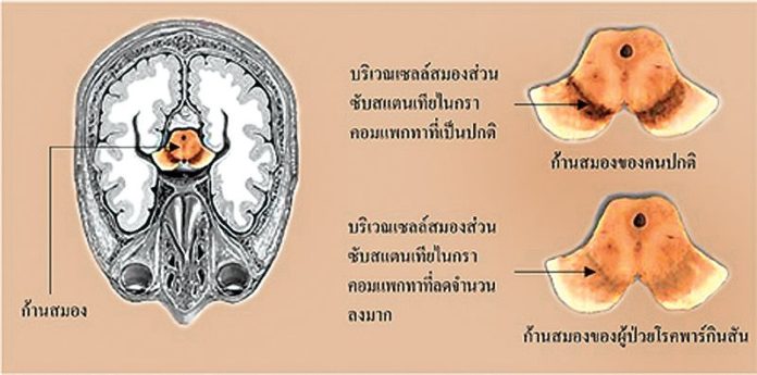โรคพาร์กินสันเพื่อประชาชน