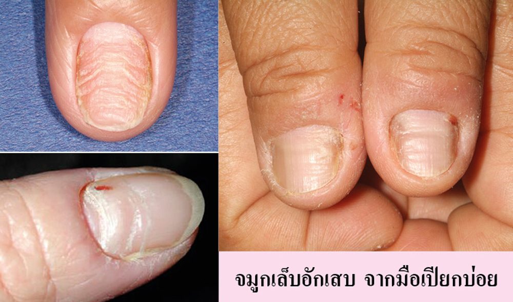 สังเกตเล็บช่วยบอกโรค