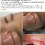 อีกอุทาหรณ์! หนูน้อย 3 ขวบฟันผุทั้งปาก ติดเชื้อรุนแรง หนองขึ้นตาหวิดบอด