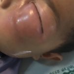 อีกอุทาหรณ์! หนูน้อย 3 ขวบฟันผุทั้งปาก ติดเชื้อรุนแรง หนองขึ้นตาหวิดบอด