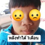 พระเจ้าช่วย!! หนุ่มจ่าย 1.4 หมื่นเสริมดั้งจมูก ผ่านไป 1 เดือนได้แค่นี้เอง!!!