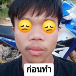 พระเจ้าช่วย!! หนุ่มจ่าย 1.4 หมื่นเสริมดั้งจมูก ผ่านไป 1 เดือนได้แค่นี้เอง!!!