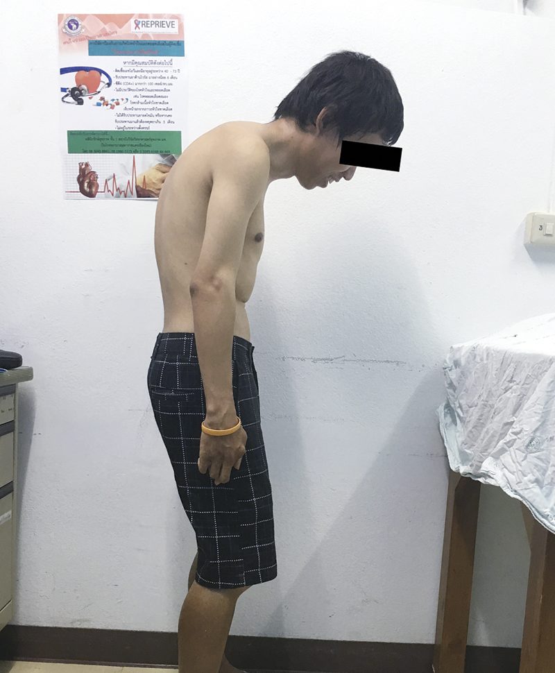โรคข้อกระดูกสันหลังอักเสบ