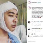 หม่อมเอ็ม ตัดสินใจครั้งใหญ่ในชีวิต ให้หมอลงมีดผ่าตัดขากรรไกร